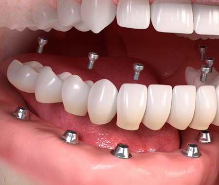 Zahnimplantate im Unterkiefer