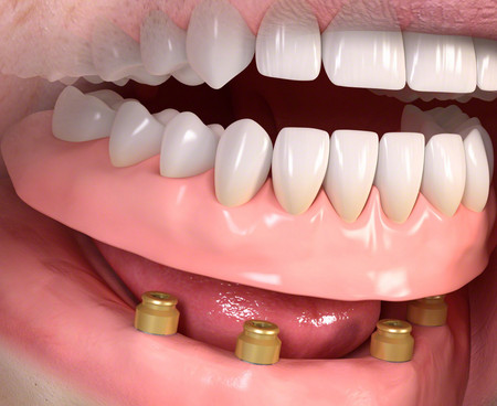 Zahnimplantate im Unterkiefer